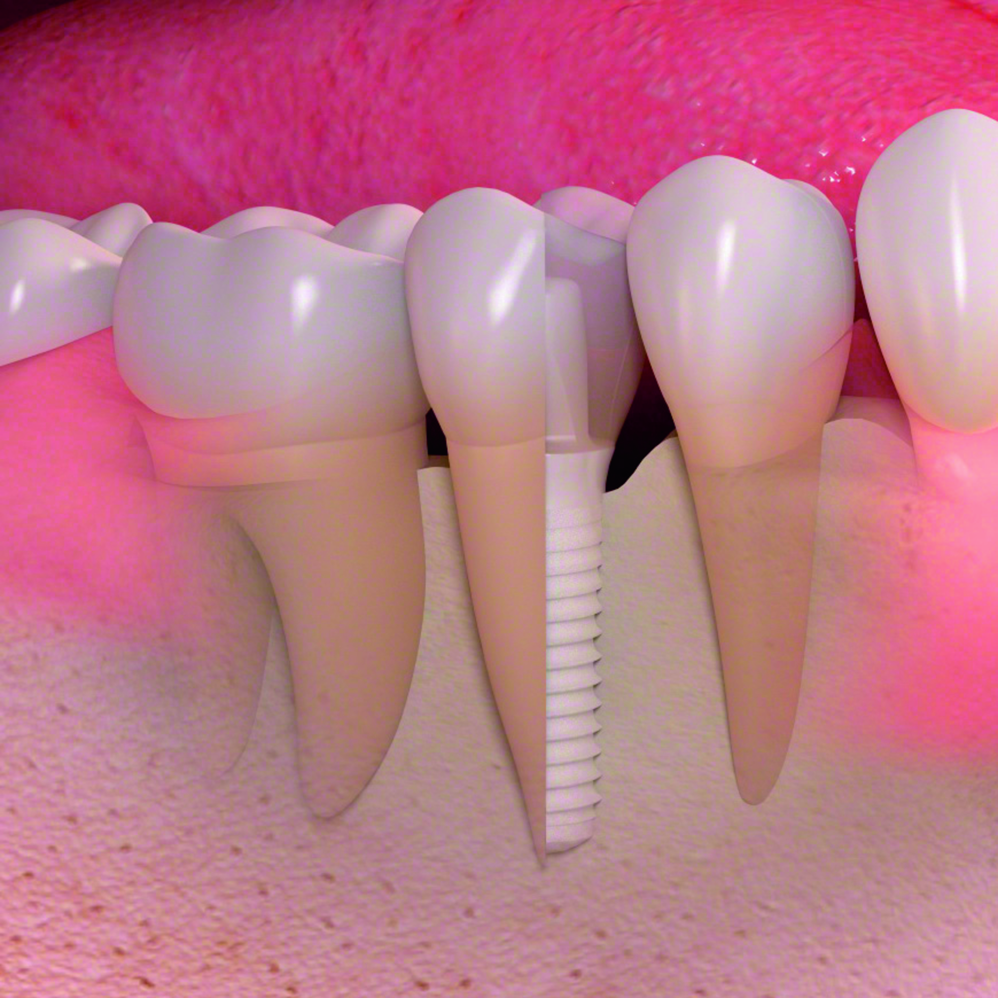 Keramikimplantat im Kieferknochen