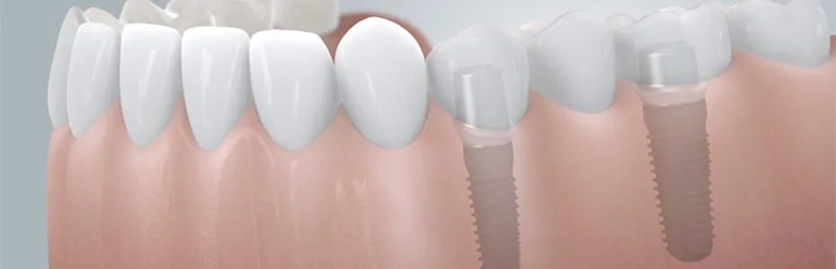 Festsitzender, implantatgetragener Zahnersatz