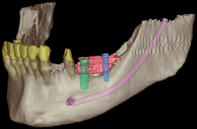 3D-Planung der Implantatpositionen im Unterkiefer