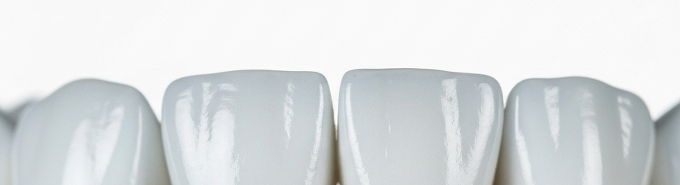 Metallfreie Keramikkronen auf dem Modell